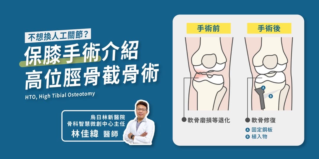 高位脛骨截骨術（HTO）——不換關節的保膝選擇