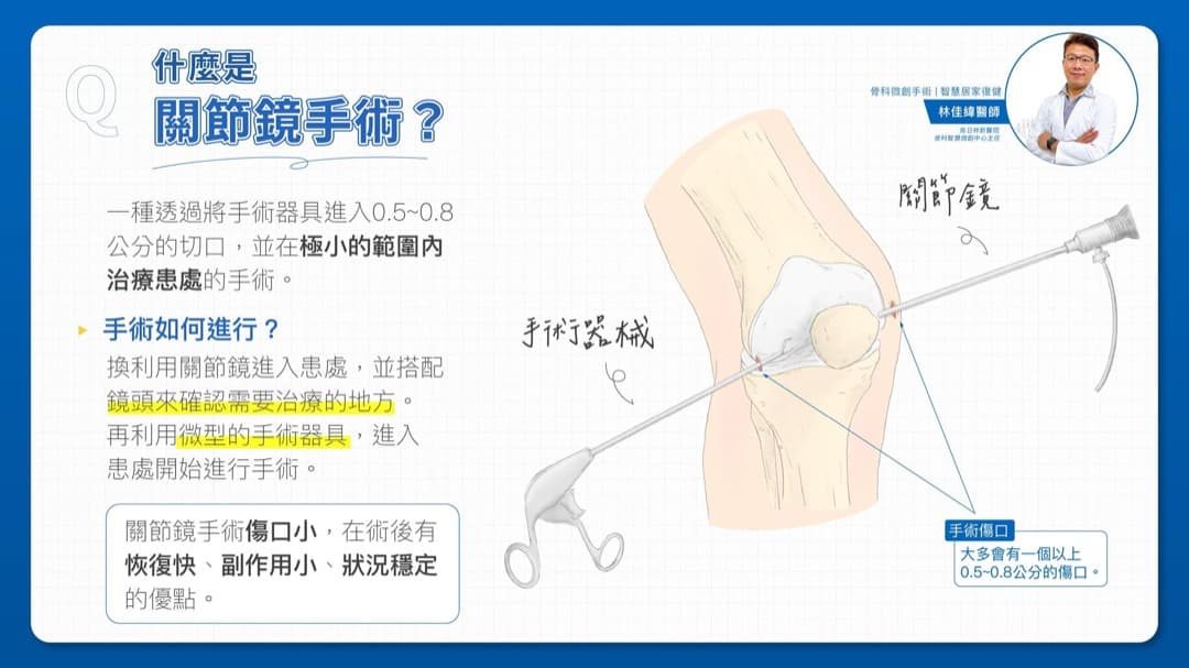 什麼是關節鏡手術 — 圖 1/1