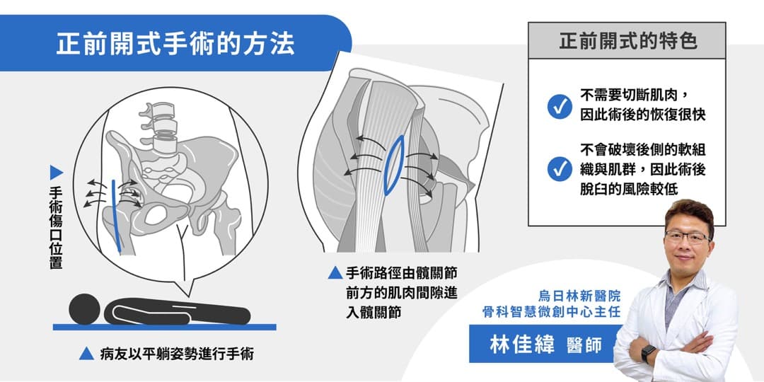 正前開式髖關節手術 — 圖 1/3