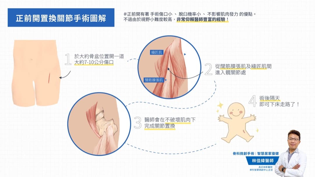 正前開式髖關節手術 — 圖 3/3