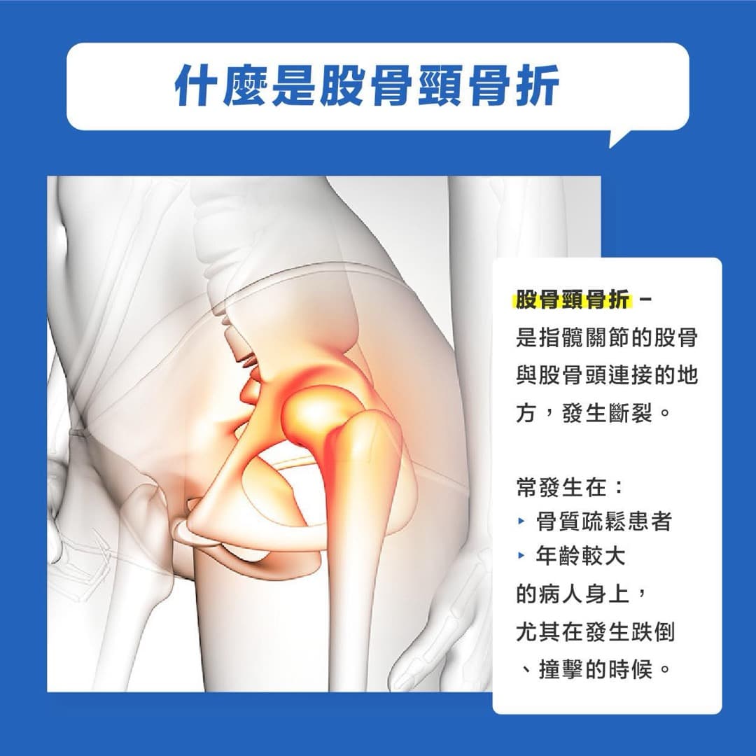 股骨頸骨折 — 圖 4/4