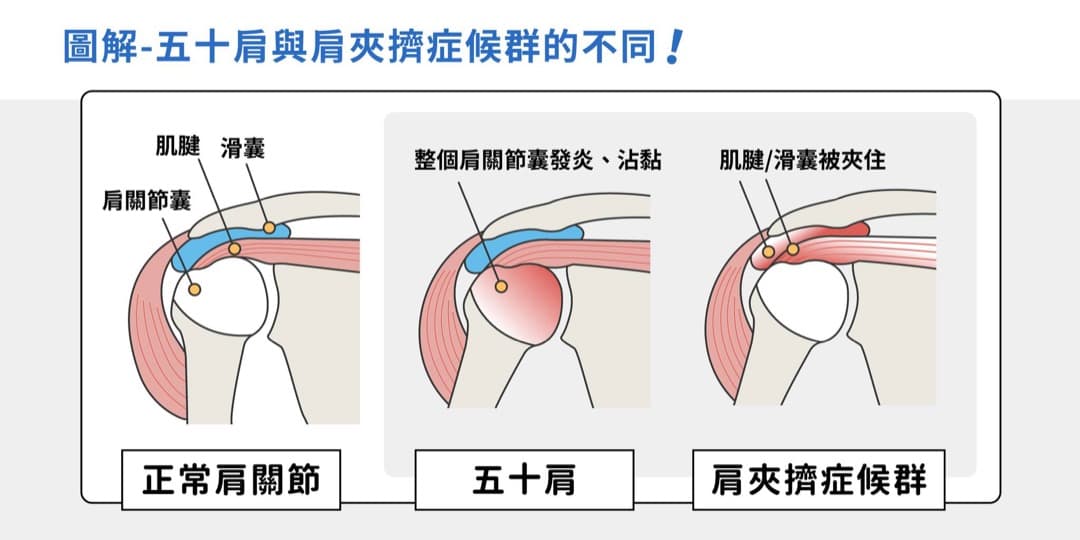 五十肩與肩夾擠症候群的比較 — 圖 2/2