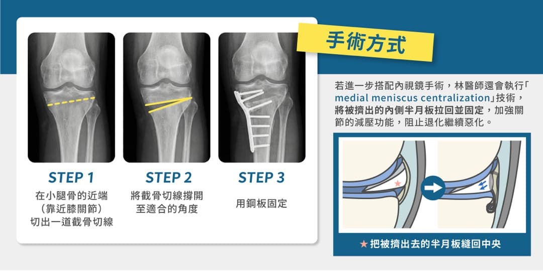 高位脛骨截骨術 — 圖 2/2