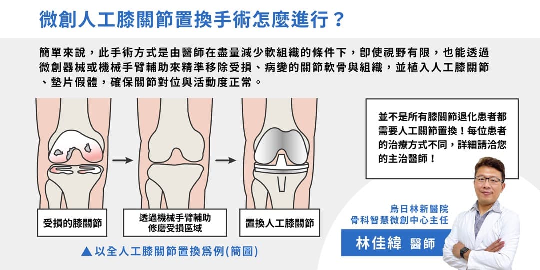 常見的膝關節微創手術——關節退化 — 圖 2/2