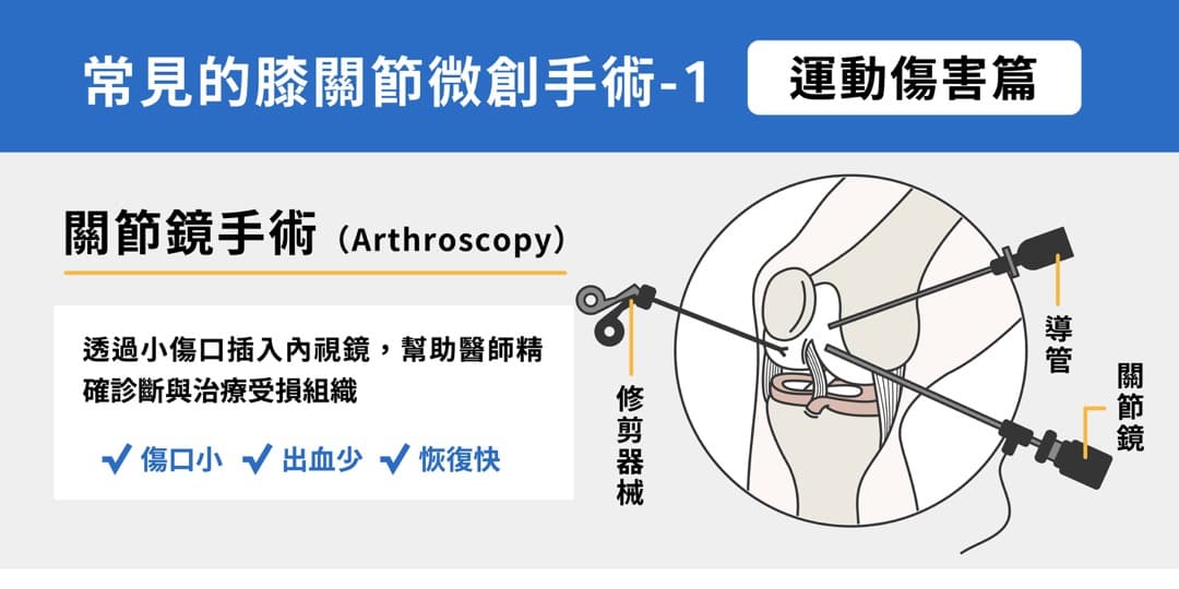 常見的膝關節微創手術——運動傷害 — 圖 1/2