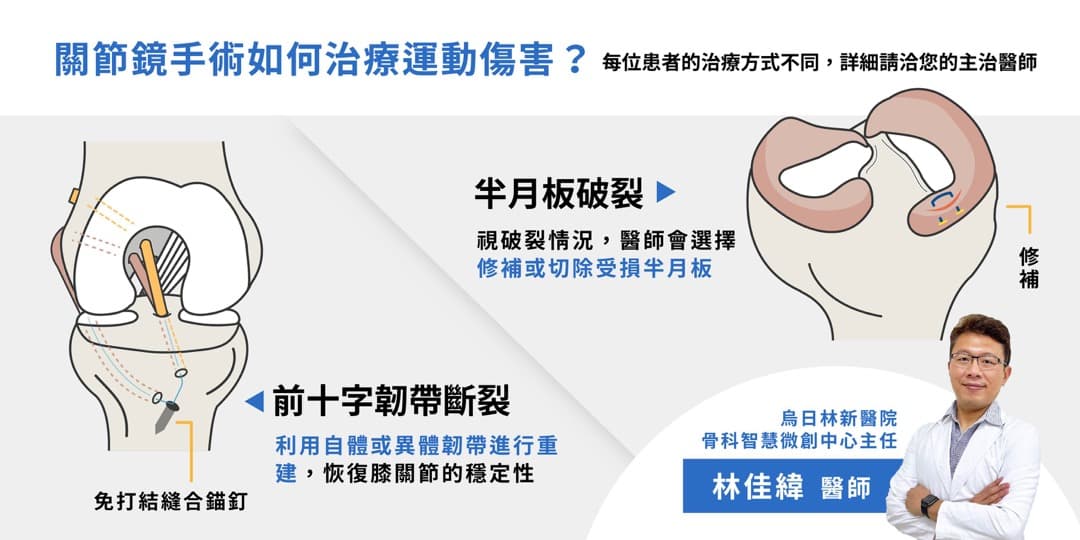 常見的膝關節微創手術——運動傷害 — 圖 2/2