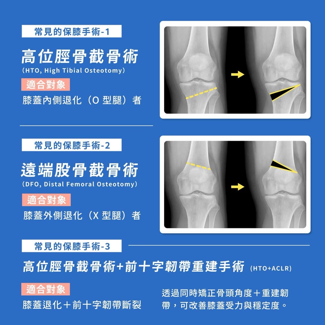 保膝手術 — 圖 3/5