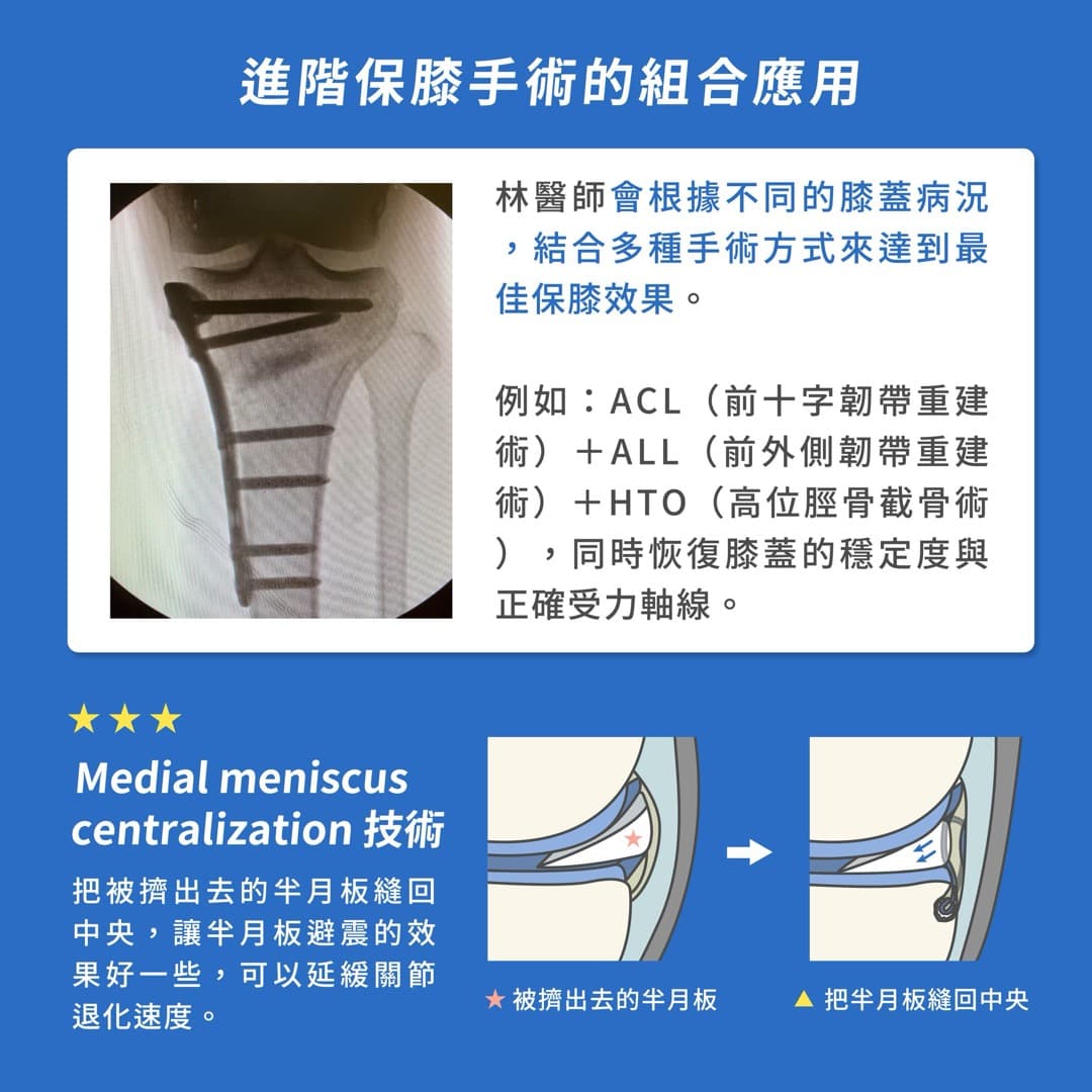 保膝手術 — 圖 4/5