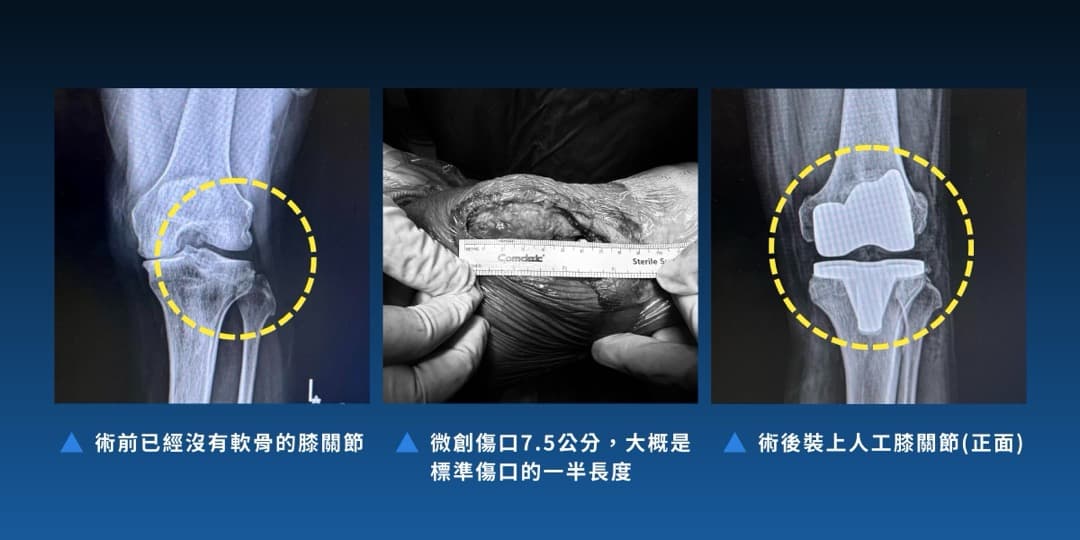 追求微創 — 圖 2/5