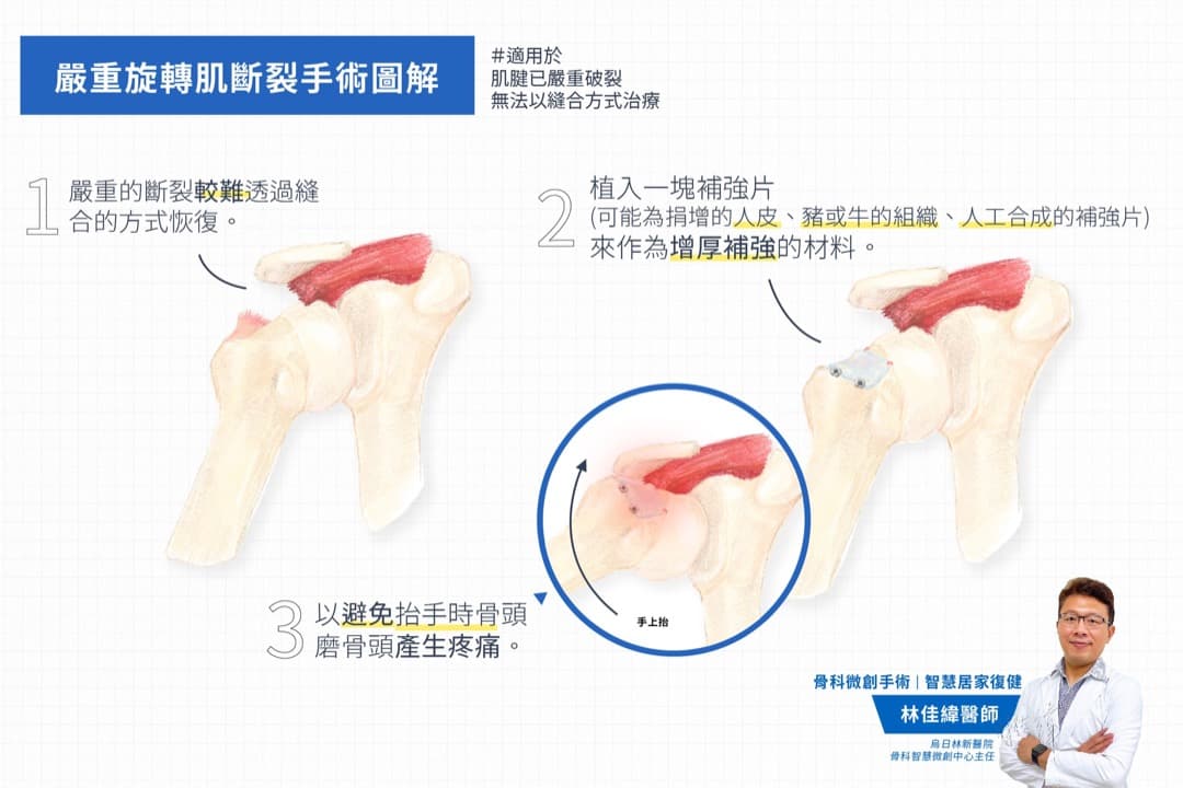 嚴重旋轉肌斷裂手術 — 圖 1/4