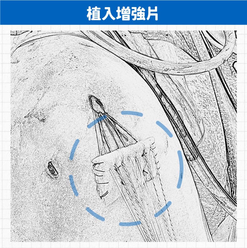 嚴重旋轉肌斷裂手術 — 圖 2/4