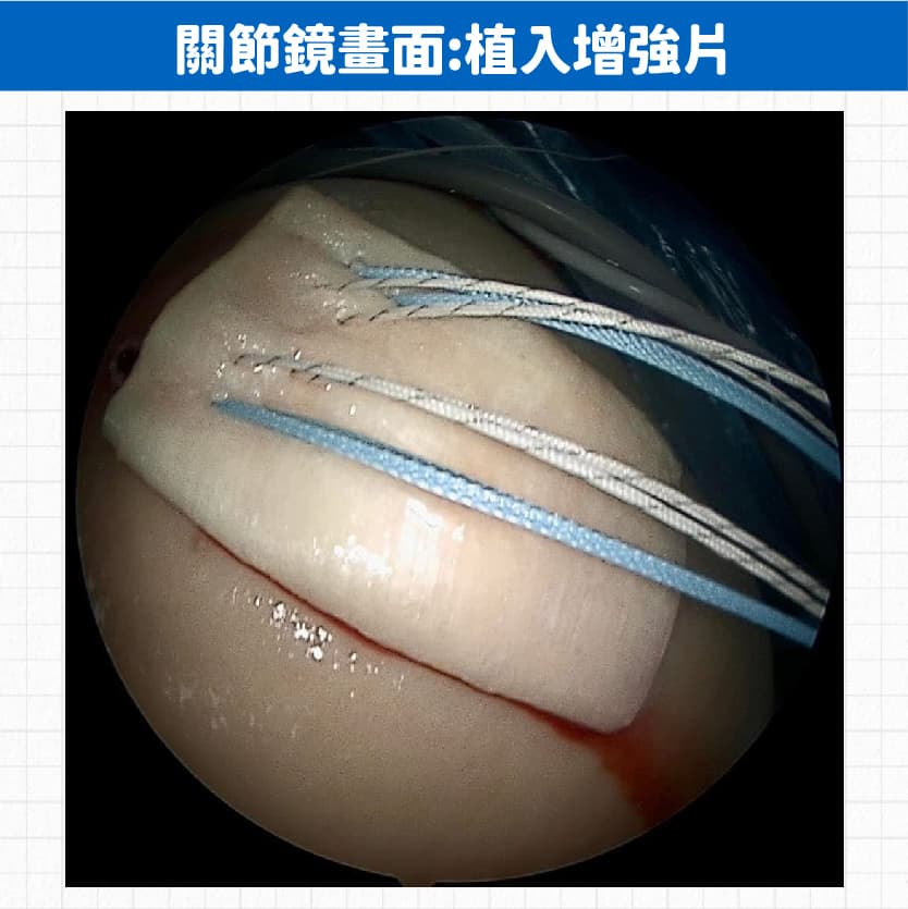 嚴重旋轉肌斷裂手術 — 圖 3/4