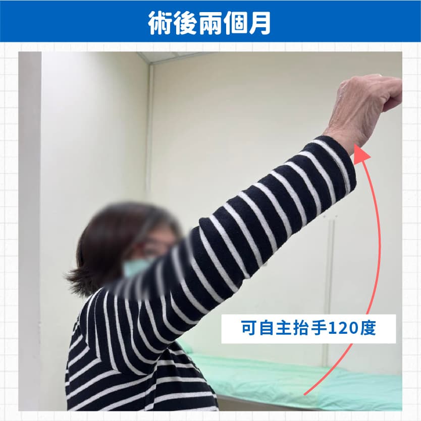 嚴重旋轉肌斷裂手術 — 圖 4/4