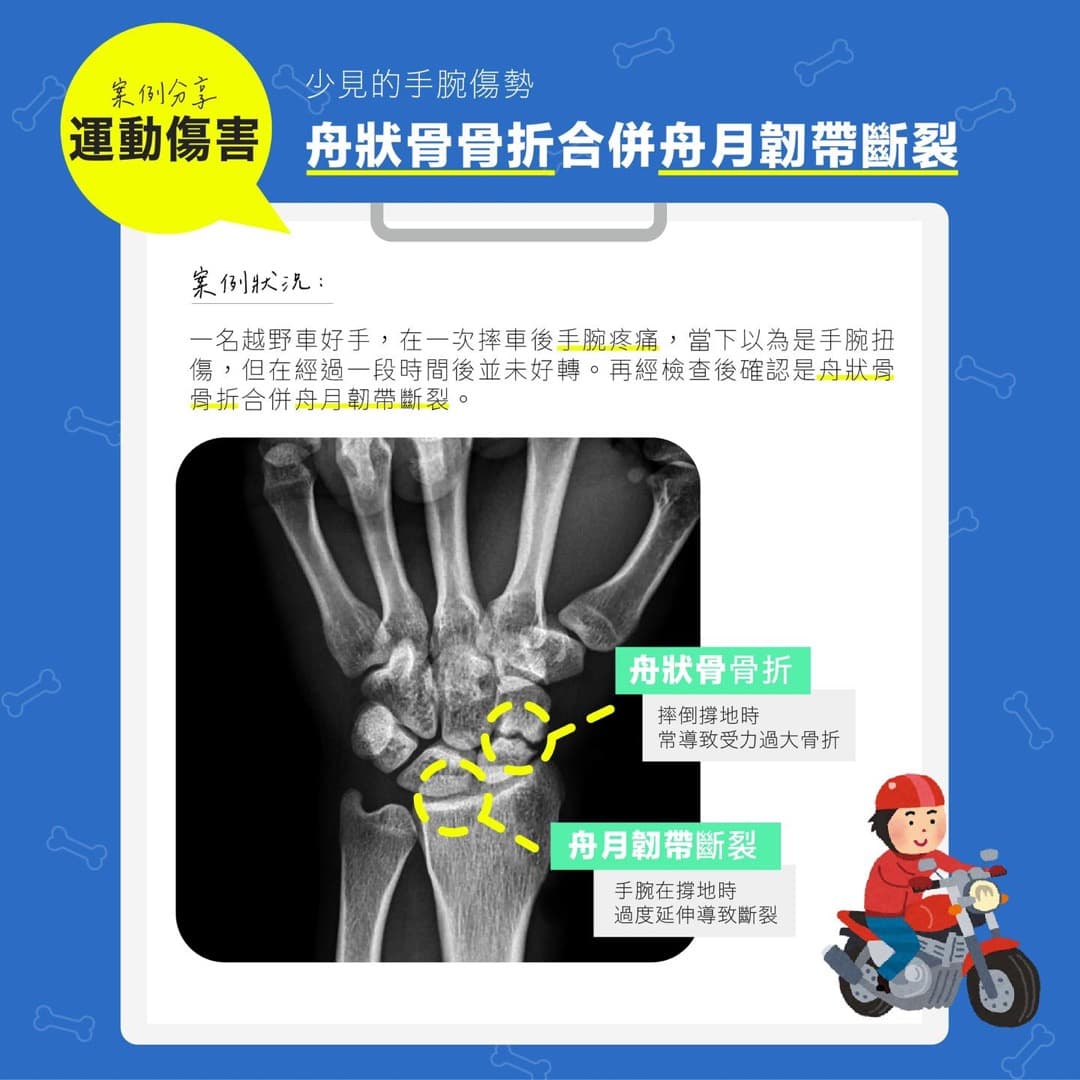 舟狀骨骨折合併舟月韌帶斷裂 — 圖 1/2