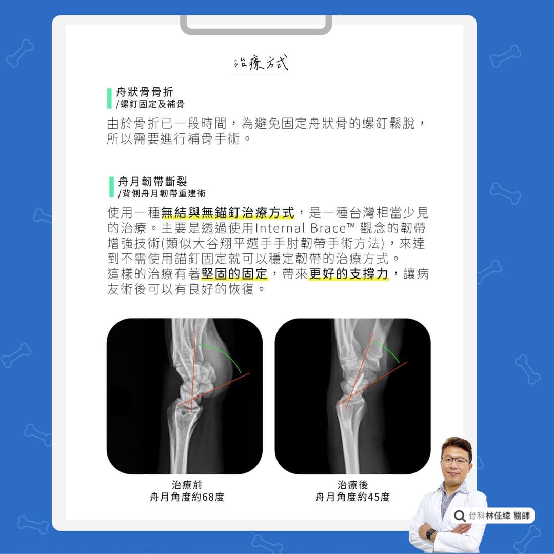 舟狀骨骨折合併舟月韌帶斷裂 — 圖 2/2